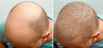 Sapphire Hair Clinic – Leading Hair Transplant Turkey Experts