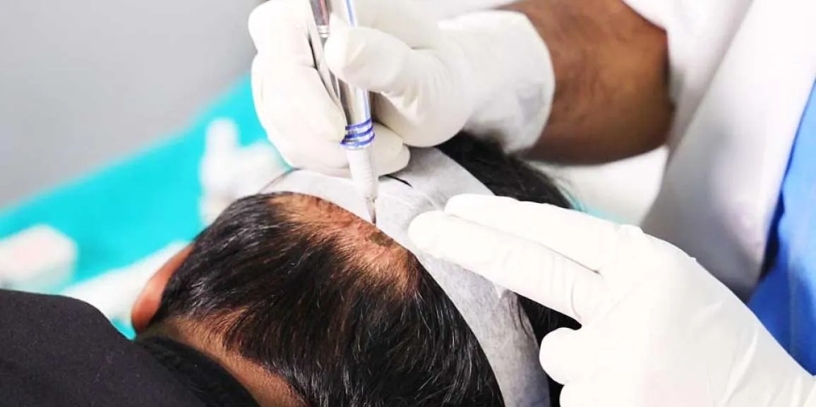 Hair Transplant London Reviews – Real Results, Real Patients