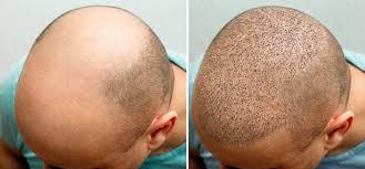 Sapphire Hair Clinic – Leading Hair Transplant Turkey Experts