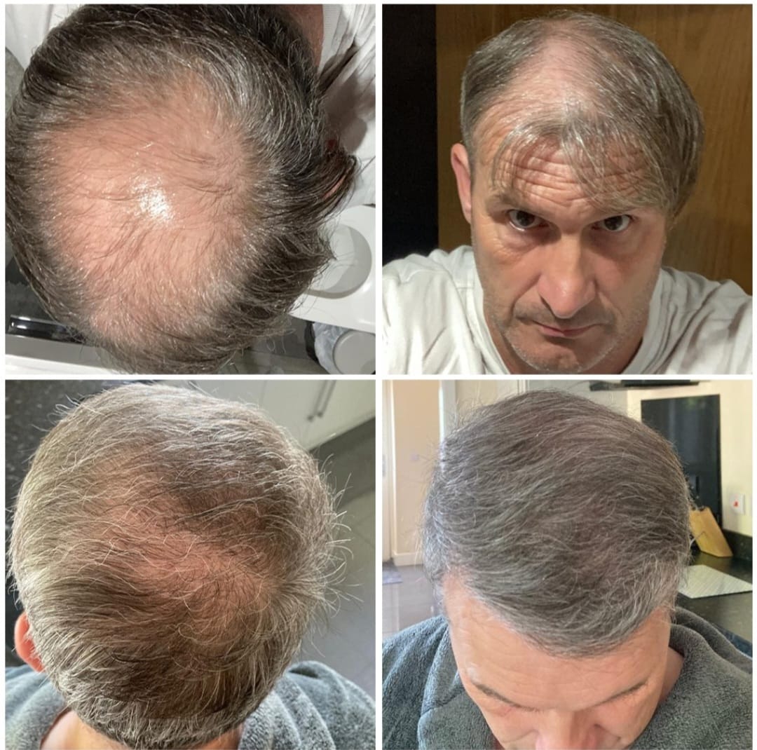 Hair Transplant London: Get Real, Permanent Hair Growth Solutions